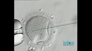 Two methods of performing ICSI Compared Aspiration ICSI Vs Penetration or Stirring ICSI [upl. by Nyliuqcaj]