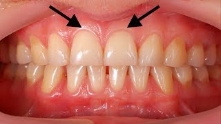 Grow Back Your Receding Gums In 2 Weeks By Only Using These Natural Homemade Remedy [upl. by Virendra]