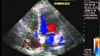 Echocardiography and Color Flow Doppler [upl. by Ynetruoc]