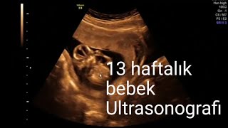 13 haftalık gebelikte ultrasonografi  bebeğin organları plasenta ve amniyos sıvısı [upl. by Bartle859]