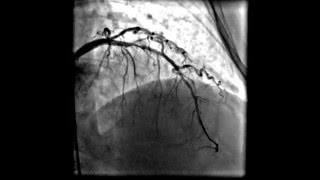 Acute anterior wall myocardial infarction [upl. by Nichola367]