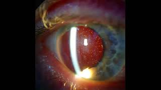 Silicone Oil in an Aphakic eye [upl. by Grantland]