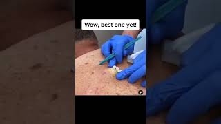 Blackheads Popping amp Blackhead Removal Videos 2022 [upl. by Ydroj41]