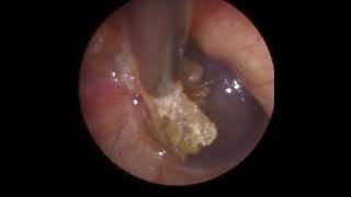 825  Cholesteatoma Ear Wax Removal [upl. by Asia3]