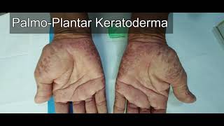 Palmoplantar Keratoderma [upl. by Dene313]