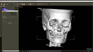 3D Orthognathic Planning with DDSPro [upl. by Ralyt]