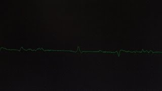 EMG Fibrillations and Fasciculations [upl. by Eizus]