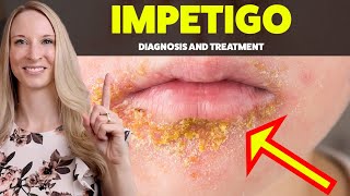 BEARD RASH IMPETIGO Diagnosis Treatment and Home Tips Explained by a Dermatologist [upl. by Leanne]