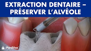 Extraction dentaire – Traitement pour préserver l’alvéole © [upl. by Ruyam586]