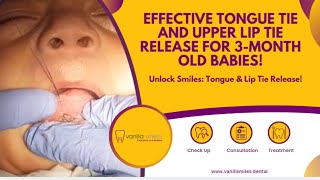 Effective Tongue Tie and Upper Lip Tie Release for 3MonthOld Babies  Vanilla Smiles Dental Clinic [upl. by Esiuol]