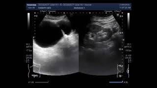 Ultrasound Video showing two cases Diverticulum of the urinary bladder and Prostatic Utricle Cyst [upl. by Yaya]