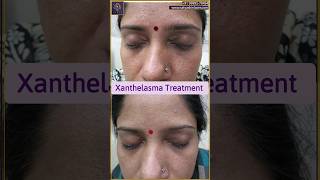 Xanthelasma removal treatment  Xanthelasma treatment laser  youtubeshort shorts xanthelasma [upl. by Shum]