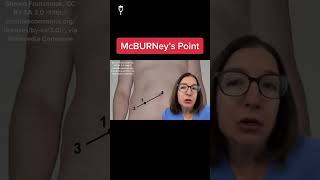 McBurneys point MedicalSurgical SHORT [upl. by Monahon]