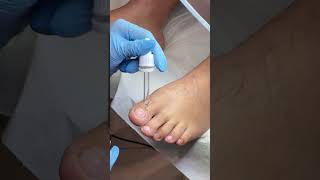 Igienizare unghii cu onicomicoză podologie pedicure unghii onicomicoses bucuresti bucurești [upl. by Anaoj138]