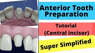 Anterior Crown Preparation  Demonstration Super Easy [upl. by Aidam800]