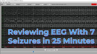 EEG with 7 seizures in 25 minutes [upl. by Thomajan]