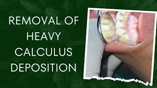 Removal of heavy calculus deposition [upl. by Suilienroc]