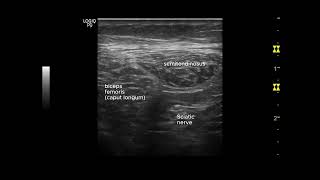 Ecografía del nervio ciático desde su origen hasta la región glútea [upl. by Nolrac]