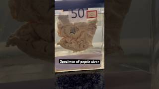 Live specimen of peptic ulcer youtube youtubeshorts [upl. by Glenna]