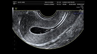 Procedimiento Histerosonografía [upl. by Cirad]