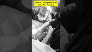 Cervical Cerclage Procedure for twin IVF pregnancy by Dr Rakshita Malik ivf pregnancy twins [upl. by Jakie]