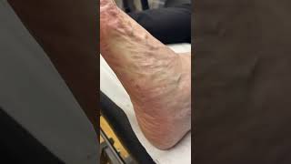 Say goodbye to corns and callus Watch our Aussie podiatrist show you how [upl. by Edurtreg933]