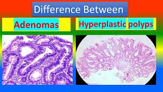 Difference between Adenomas and Hyperplastic Polyps [upl. by Rehnberg702]