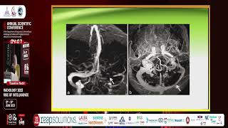 Pearls and Pitfalls in The Magnetic Resonance Diagnosis Of Dural Sinus Thrombosis [upl. by Nikolos]