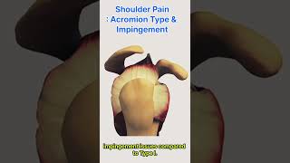 Shoulder Pain  Acromion Type and Impingement Syndrome [upl. by Ecart]