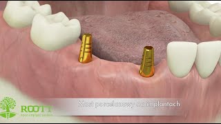 Uzupełnienie braków zębowych za pomocą mostu na dwóch implantach [upl. by Asselim650]