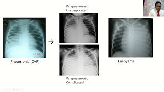 EmpyemaParapnemonic Effusions [upl. by Chrissie371]