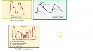 Medicine PULSUS PARADOXUS pulse reverse [upl. by Imogen]