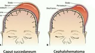 Caput succedaneum vs cephalhematoma [upl. by Sheryl536]