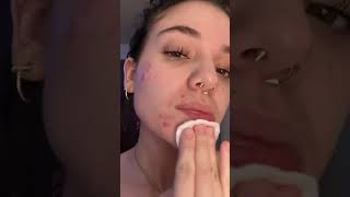 1 Week Glycolic Acid Results 🫧🧖🏼‍♀️ skin acne beauty facial glowingskin healthyskin [upl. by Daphne]