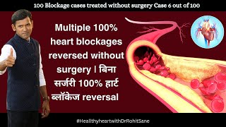 Multiple 100 heart blockages reversed without surgery  बिना सर्जरी 100 हार्ट ब्लॉकेज reversed [upl. by Orthman]