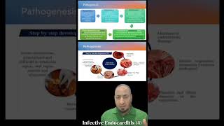 Infective Endocarditis 4 pathogenesis التهاب الشغاف المعدي microbiology medicalstudent [upl. by Gaye]