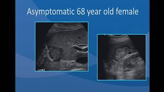 sonography of Focal Liver Lesions [upl. by Stonwin195]