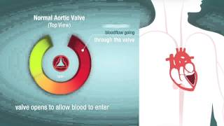 Valve Stenosis When a Heart Valve is Too Narrow [upl. by Nirak]