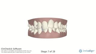 MiSmile Network  ClinCheck Example for a Complex Case [upl. by Afital532]