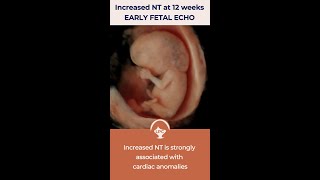 Early Fetal Echocardiography for fetuses with increased NT by Dr Fred Ushakov [upl. by Ecirtael503]