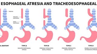 TRACHEOESOPHAGEAL 🫁FISTULA TEFESOPHAGEAL ATRESIA👍🏻HINDI msnpediatrics tracheoesophagealfistula [upl. by Weinhardt]