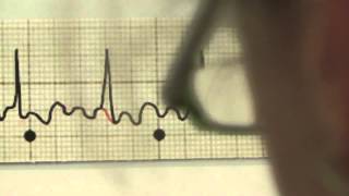 EKG für Pflege Teil 20  Vorhofflattern interpretieren [upl. by Artima48]