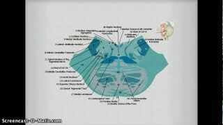 Medial Inferior Pontine Syndrome pics [upl. by Toombs]