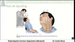 Radiculopatía cervical diagnóstico diferencial [upl. by Erfert]