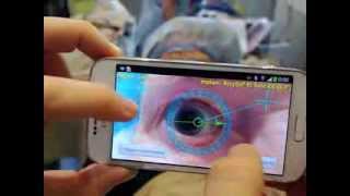 TOREASY  first noncontact Smartphone enabled eye marking for toric IOLs [upl. by Munford]