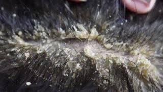 Dandruff scratching removal on head using black combing390 [upl. by Salahcin]