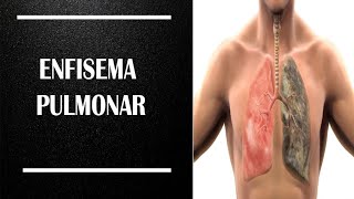 Enfisema Pulmonar Causas sintomas e tratamentos  Tribuna Independente  151018 [upl. by Lisandra]