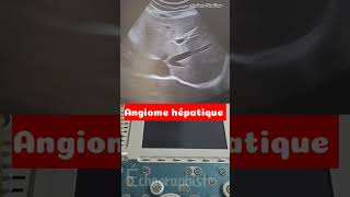 Échographie abdominale Angiome hépatique medical docteur pregnant science flowers [upl. by Nnayelhsa]