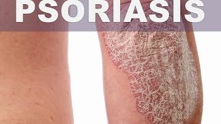 ☞Remedios caseros para los síntomas de la psoriasis –Parches gruesos escamosos y picazón en la piel [upl. by Ecnerrot]