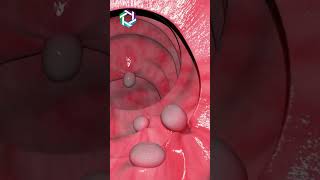 Colonoscopy Procedure See What Happens amp how it works  Dr Jitesh Rajpurohit [upl. by Nilat]